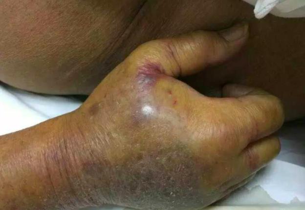 食肉菌感染有多可怕,食肉菌是不是罕见病菌