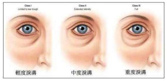 3个经典手法轻松告别泪沟,各个方法消除泪沟视频