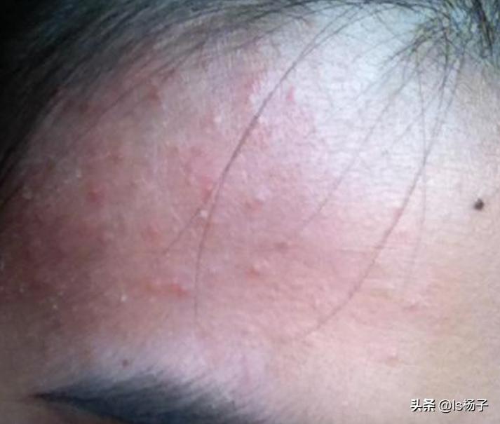 脸上都是小米粒疙瘩冒白头且痒,红疙瘩有白尖里边有白色小米粒