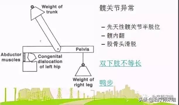 常见的异常步态醉酒步态,步态异常的十大特征有哪些图片