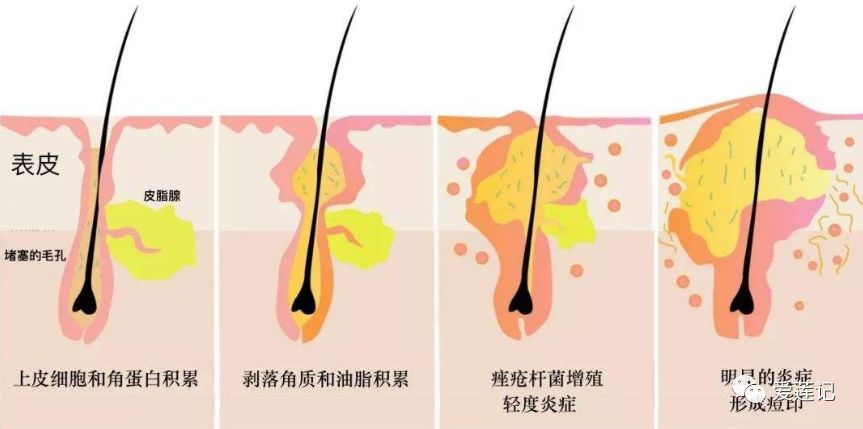 痘印红色的好治还是黑色的好治,红色痘印黑色痘印