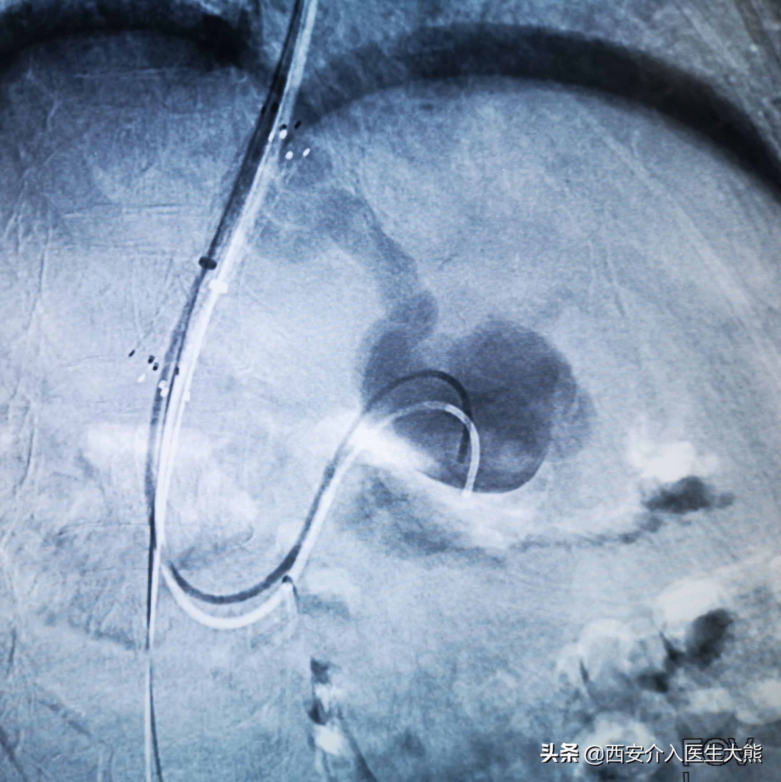 肝硬化消化道出血的病例护理讨论,肝硬化引起的消化道出血如何治疗