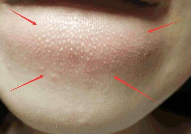 下巴长粉刺如何调理好得快,下巴长粉刺的原因和改善方法女生