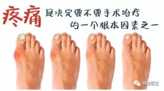 拇外翻治疗视频大全,治疗拇外翻最好医院