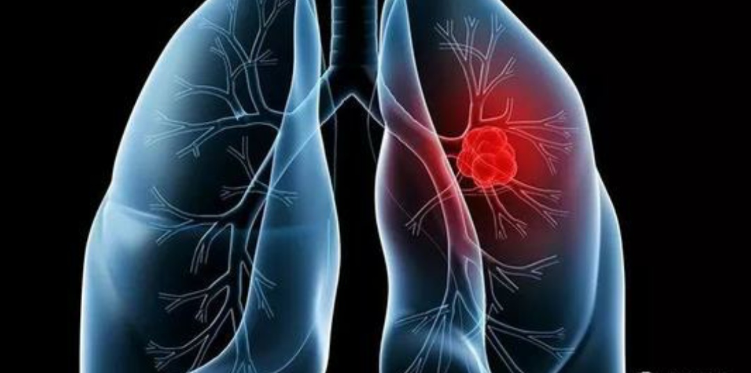 小儿肺栓塞的症状及治疗,儿童肺部血栓有什么好的治疗方法