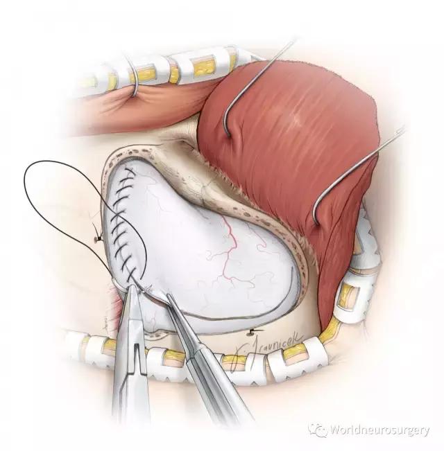 翼点入路技巧图解,翼点入路的开颅要点