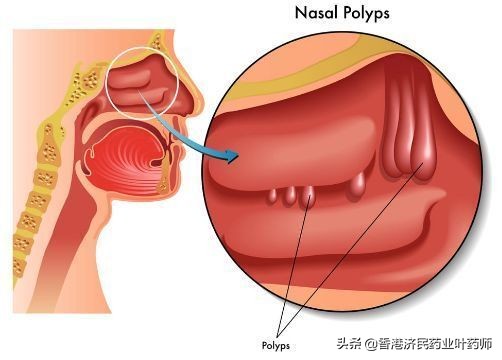 慢性鼻窦炎伴鼻息肉靶向药Nucala获批，缩小鼻息肉、改善鼻阻塞
