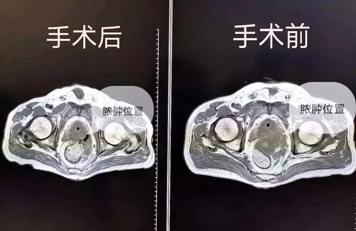 广州市八医院重症患者,多科协作成功抢救宫外孕患者