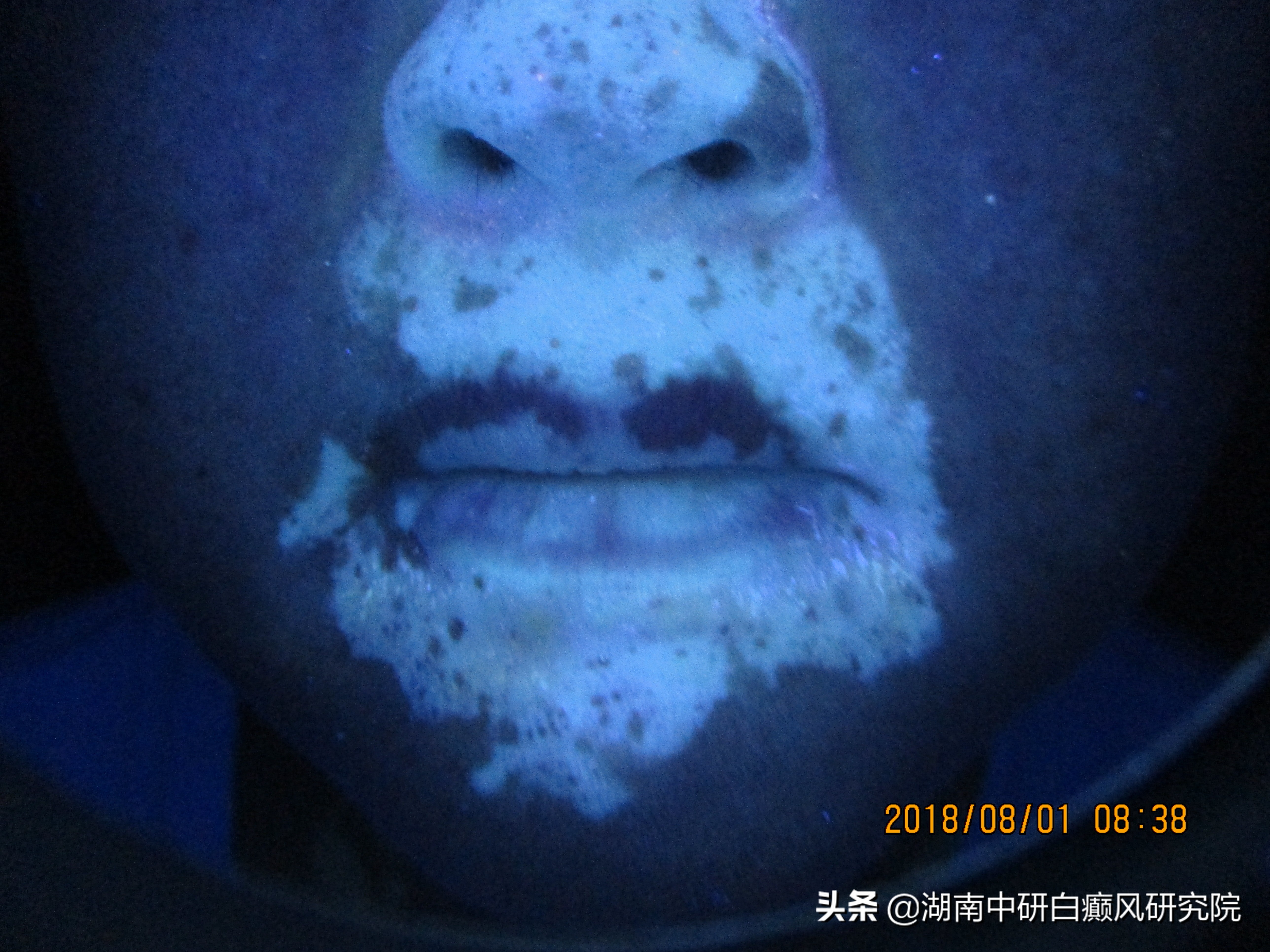 一位面部白癜风的患者，从患白到康复，她经历了什么？