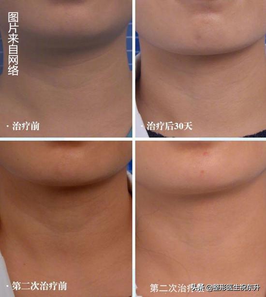 你的皱纹是怎样的,你的颈纹是这样的吗