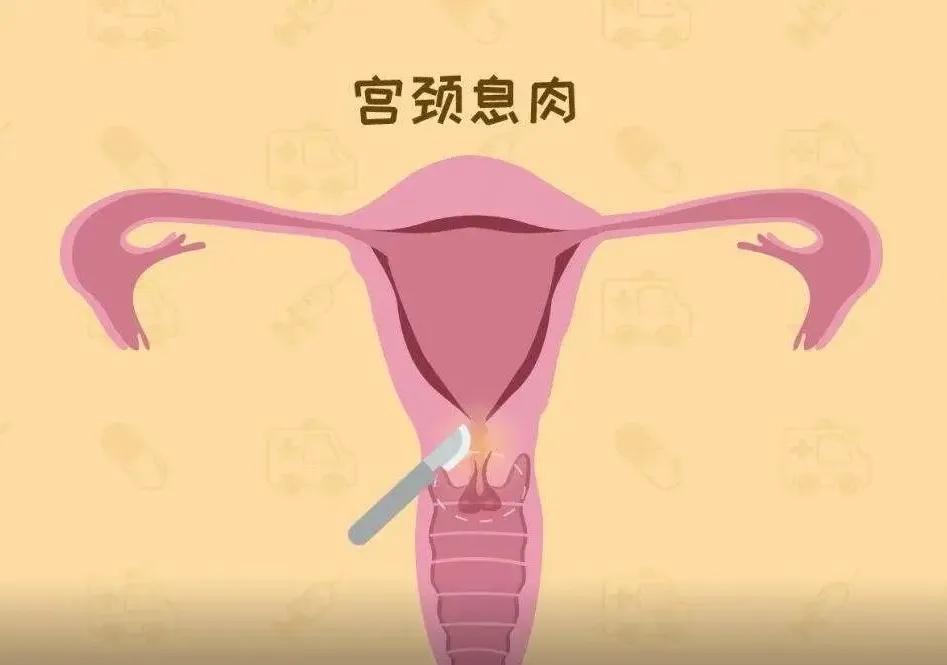 宫颈炎不治疗会影响怀孕吗,宫颈炎不治疗会引发宫颈癌吗