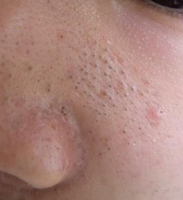 顽固黑头怎么去除最有效,祛除黑头最有效的方法