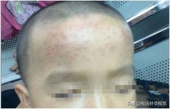 八个月宝宝发烧贴退热贴管用吗,小孩发烧退热贴真的有用吗