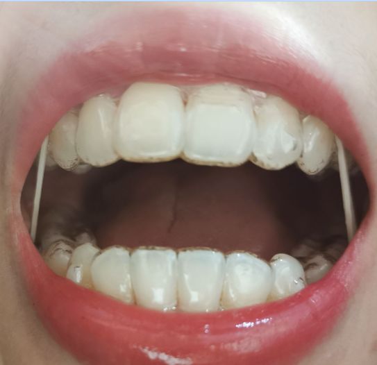 杭州牙齿龅牙矫正,牙齿矫正记录隐适美