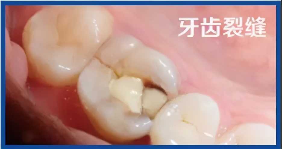 根管治疗做冠的牙齿会裂开吗,根管治疗后牙齿裂了还能做外冠吗