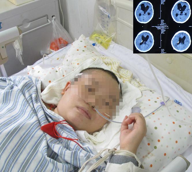 结核性脑积水,脑膜炎脑积水要治疗多久