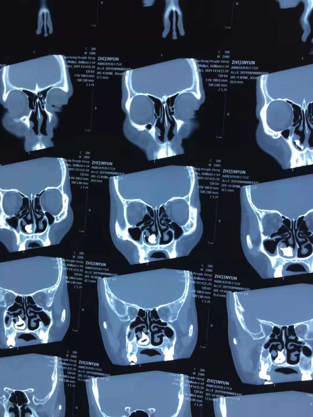 耳鼻喉科完成我院首例鼻内镜下巨大鼻石取出术