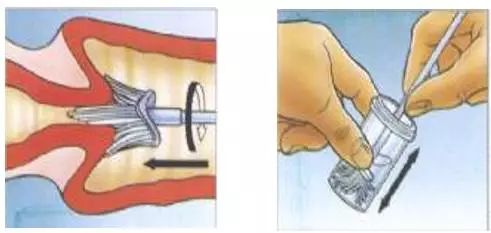 女人需要做宫颈癌筛查吗,子宫切除还需要做宫颈癌筛查吗