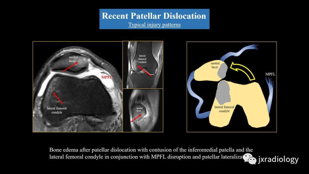 髌股关节失常磁共振看什么,髌股关节混乱的影像评估