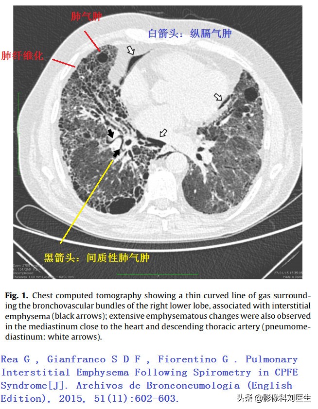肺气肿治疗权威专家,老年人肺部疾病有哪些