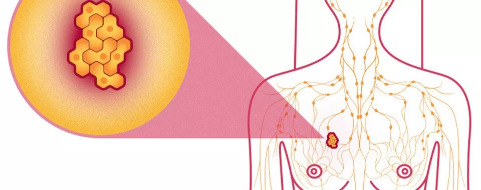 女性12个症状要警惕乳腺癌,女性癌症头号杀手的特点