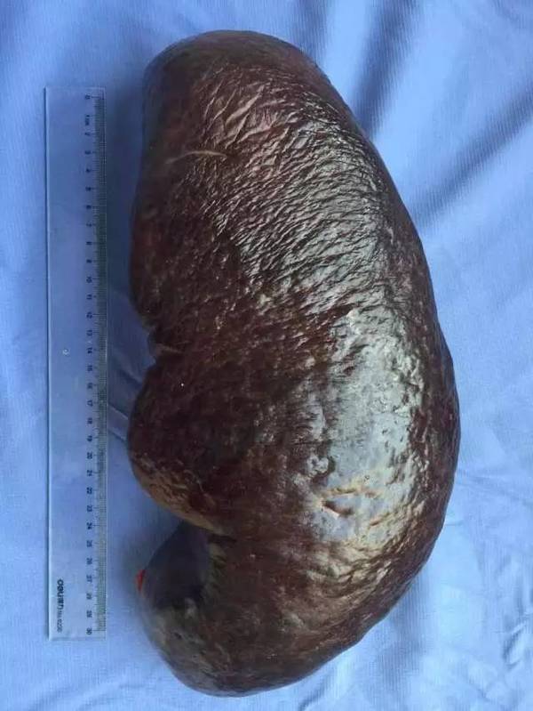 引起脾亢的原因,脾亢一定要切除吗