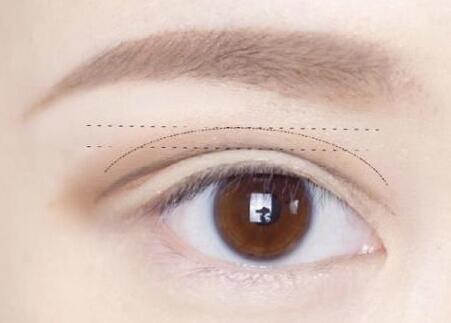 割双眼皮后眼角有点红肿怎么办,割双眼皮后眼睛发炎怎么办