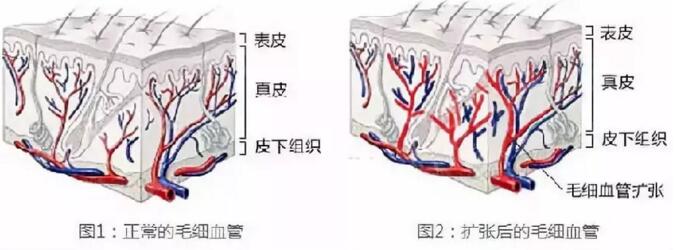 宝宝长红斑痣怎么消除,宝宝有红色胎记怎么治