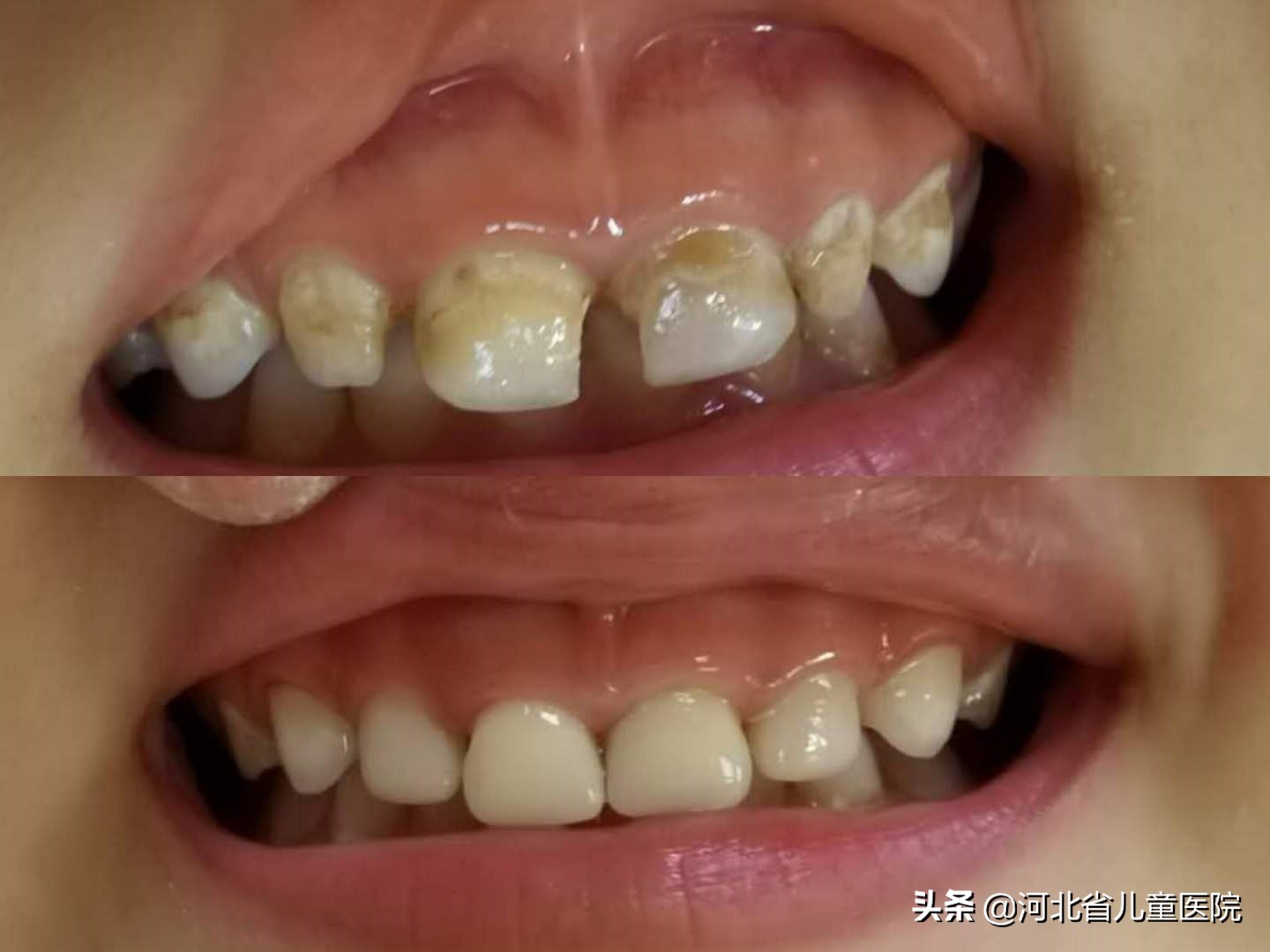 【注意】孩子牙齿龋坏、变黑怎么办?