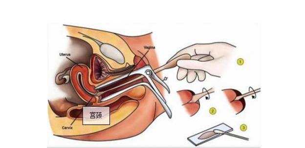 宫颈癌六大误区,宫颈癌要做什么检查才能检查出来