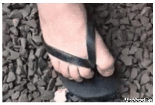 脚气的危害和注意事项,脚气的注意事项及治疗误区