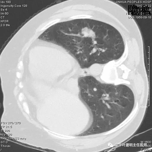左肺下叶恶性病变,左肺上叶和下叶都有血管畸形