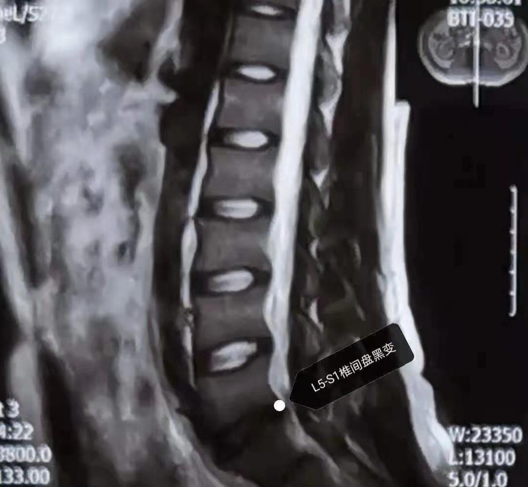 中医正骨咔咔响合集,中医正骨骨头咔咔响的声音