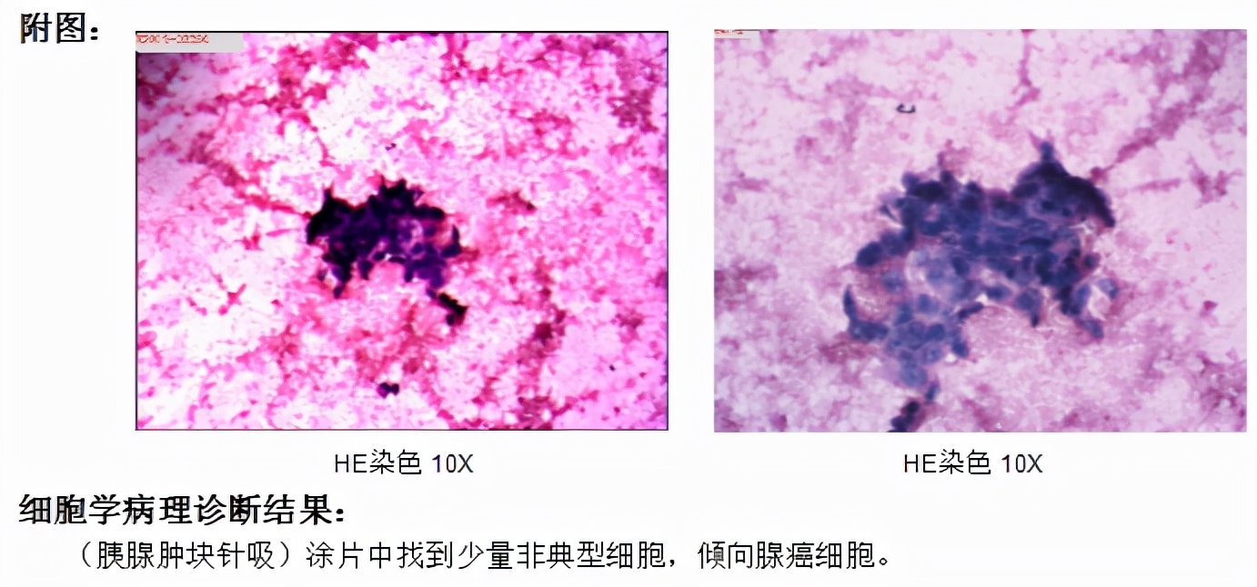 胰腺癌胃痛是什么情况,胃痛和胰腺炎区别与图片