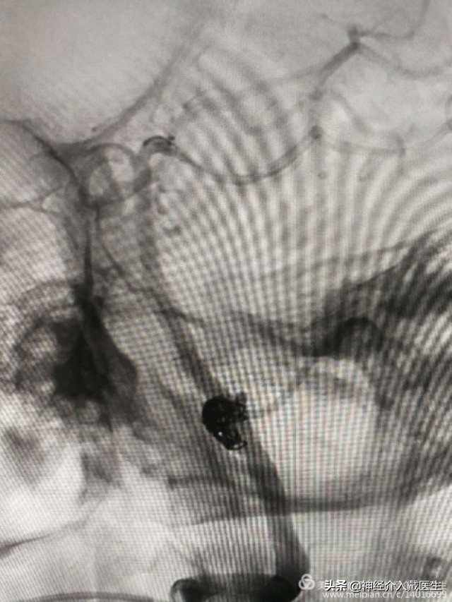 神经外科手术动脉瘤,湖南省人民医院脑动脉瘤介入治疗