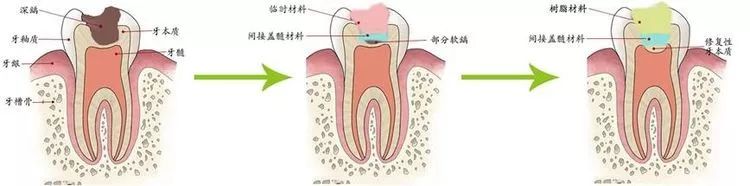 疫情防控在家牙疼怎么办,不小心咬到蛀牙牙痛怎么办