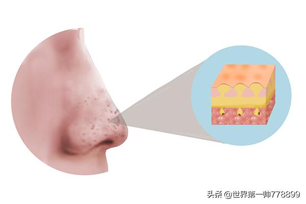 鼻子红红的一挤有白色分泌物,鼻子两边一挤很多白的分泌物