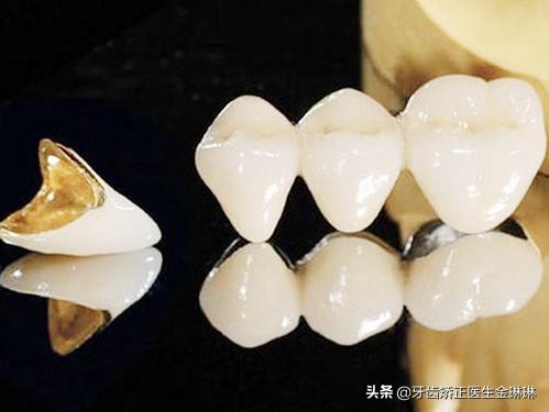 牙医说装烤瓷牙冠,牙医做牙冠疼吗