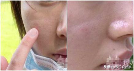 女子打童颜针长脓包3年没工作,女子打水光针花了17万