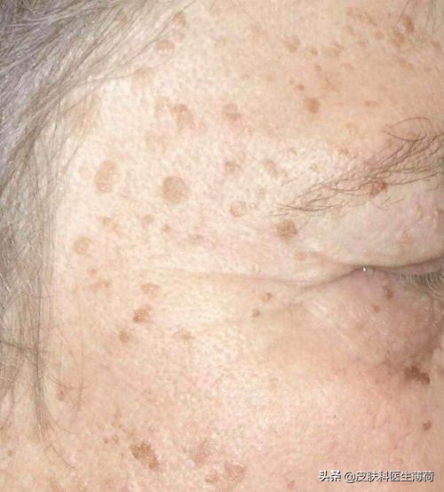 脸上有斑是做冷冻还是激光,黄褐斑用激光祛好还是吃中药