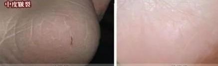 脚容易出汗怎么办？鞋臭怎么办？只需一招轻松搞定