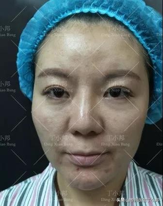 全脸填充脂肪饱满一点好不好看,脂肪填充太饱满怎么样消除