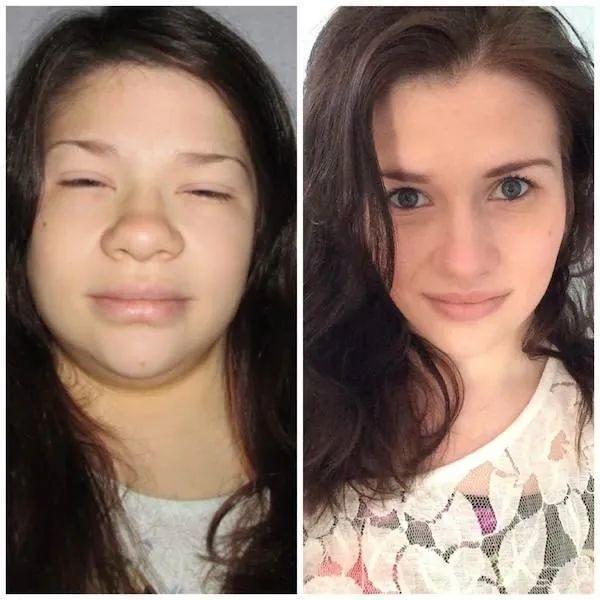 早上脸部浮肿快速消肿是什么原因,脸浮肿的原因及解决方法