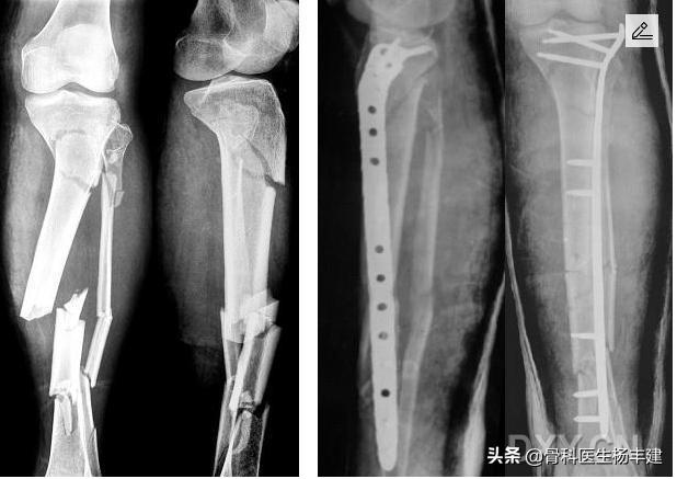 骨折手术后需要注意，什么情况下容易出现钢板断裂？