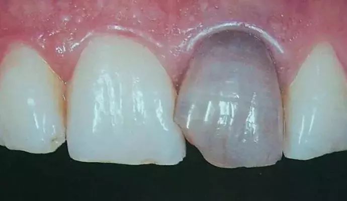 什么情况下牙齿需要做牙冠,牙齿抽掉神经需要戴牙冠吗