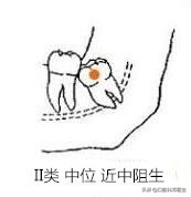 智齿分轻重嘛,智齿水平和非水平的区别