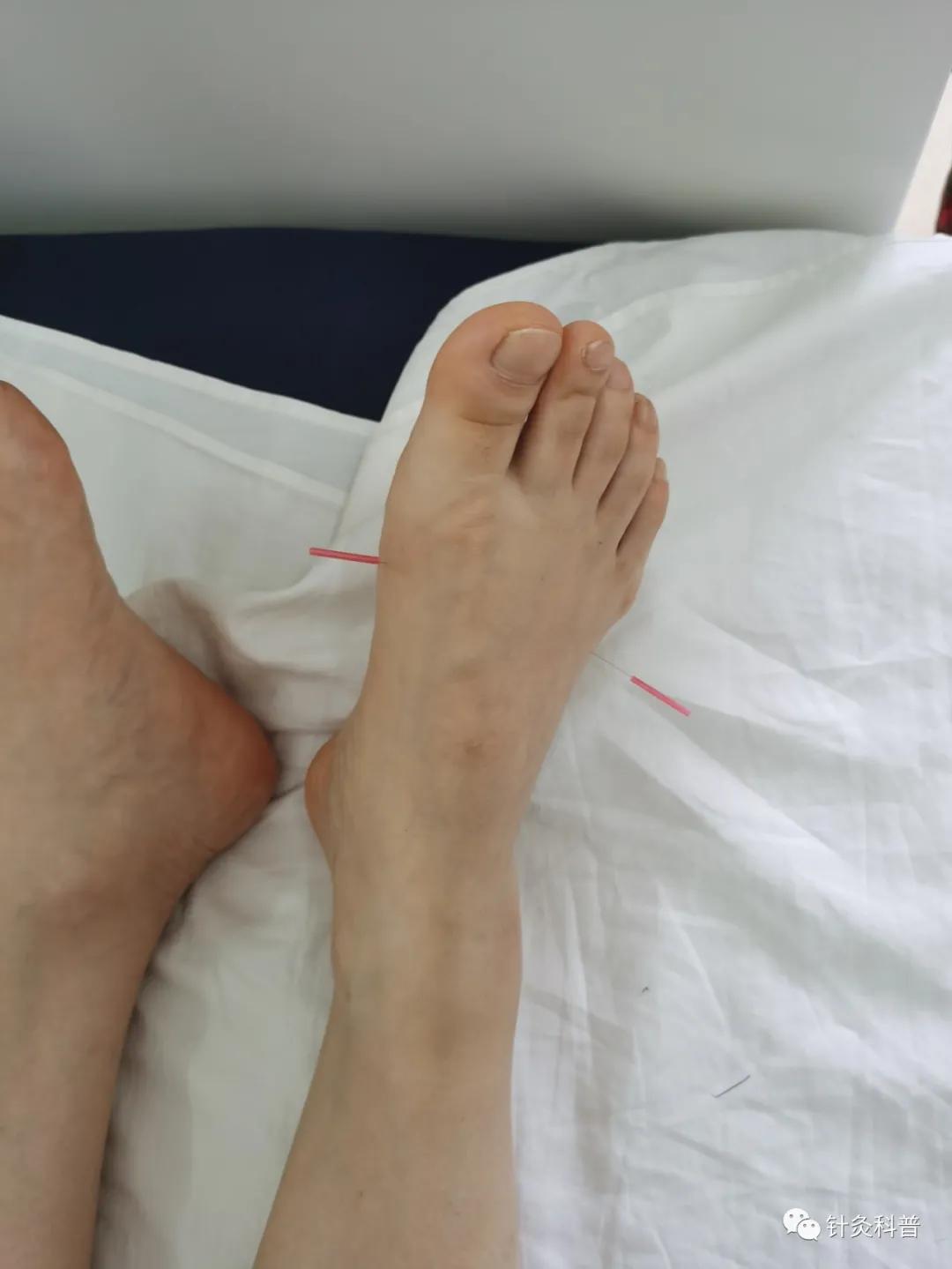 针灸后偏头痛是怎么回事,针灸治疗偏头痛是什么原理