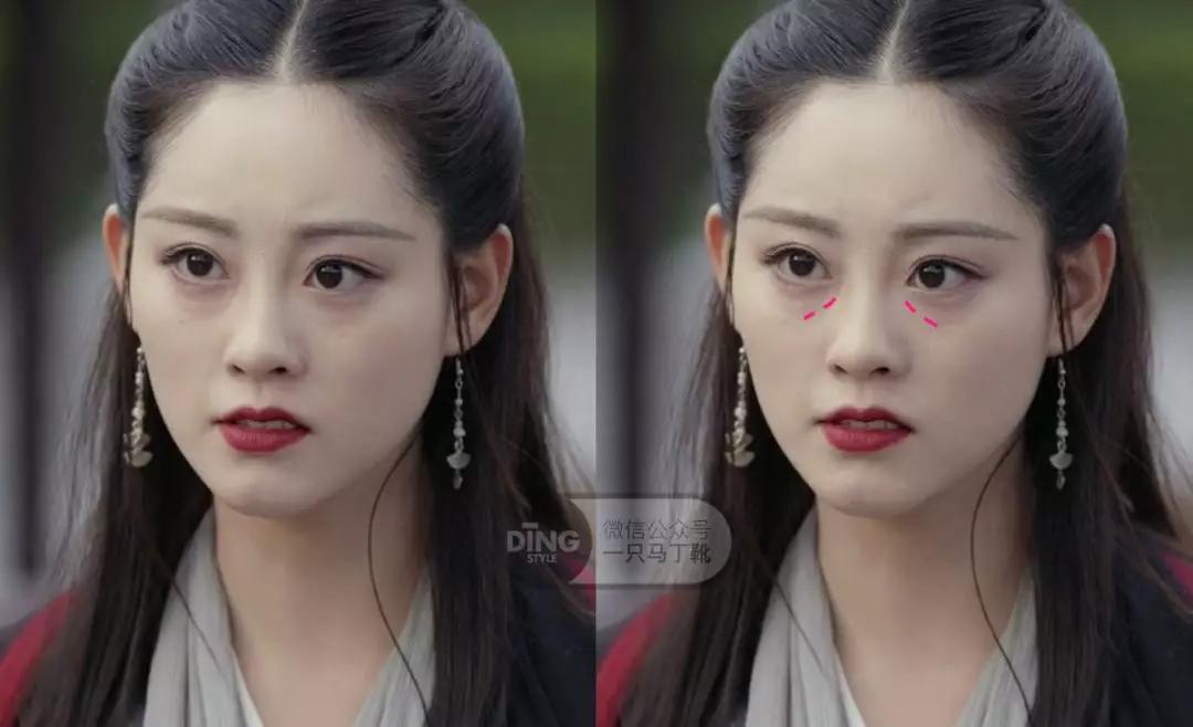 颧弓高脸型怎么改善,有泪沟可以通过调整脸型改善嘛