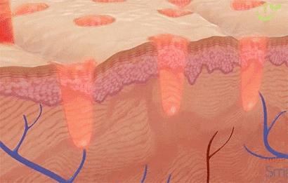 该怎样从源头上改善成人痘印痘坑,祛红痘印黑痘印医美