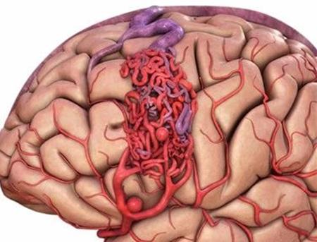 脑动静脉畸形可选用的栓塞物,脑动静脉畸形做伽玛刀后康复